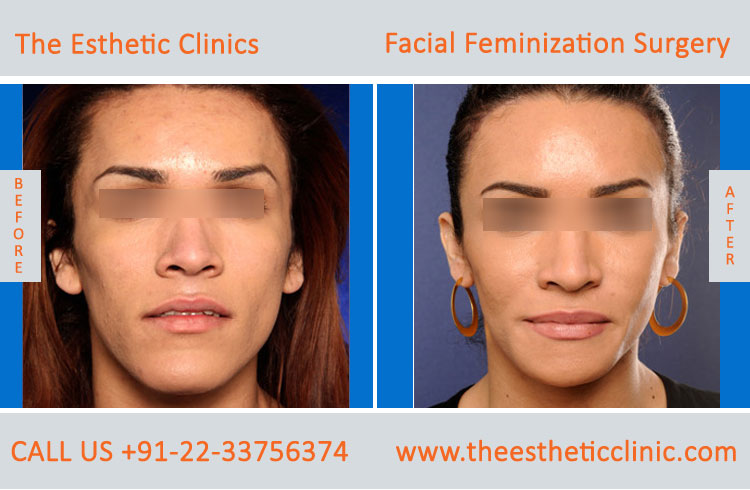 Facial Feminization Surgery before after photos in mumbai india (1)